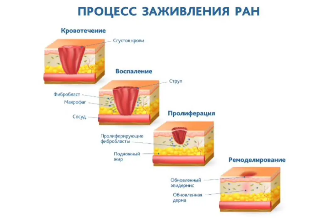 Процесс заживления ран
