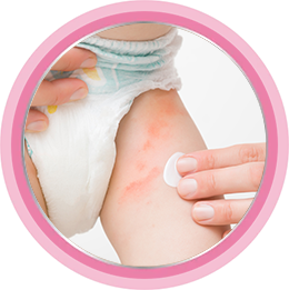 Что такое опрелости