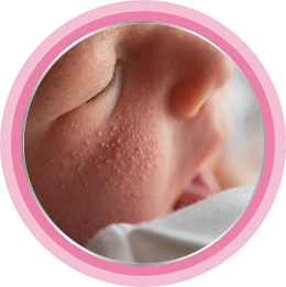 Акне у новорождённых