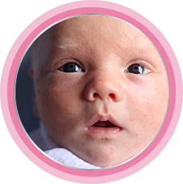 Что такое акне новорождённых