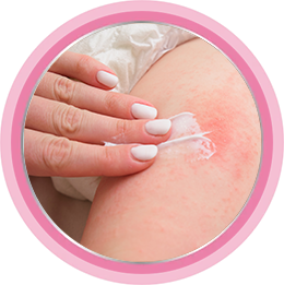 Профилактика опрелостей у детей